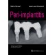 Peri-implantitis