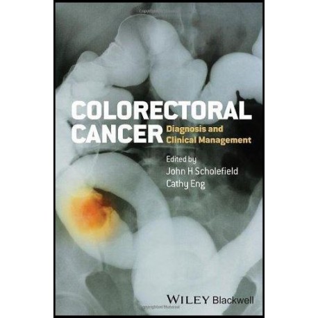 Colorectal Cancer: Diagnosis and Clinical Management 1st Edition