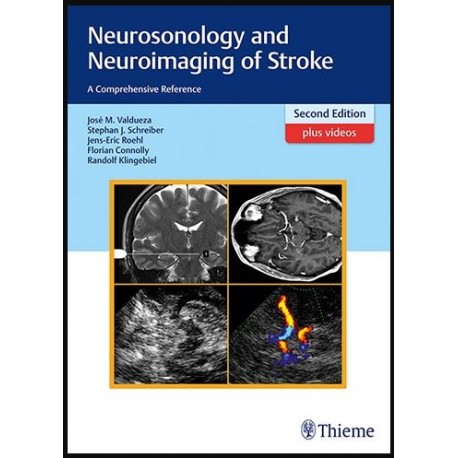 Neurosonology and Neuroimaging of Stroke: A Comprehensive Reference 2nd edition Edition