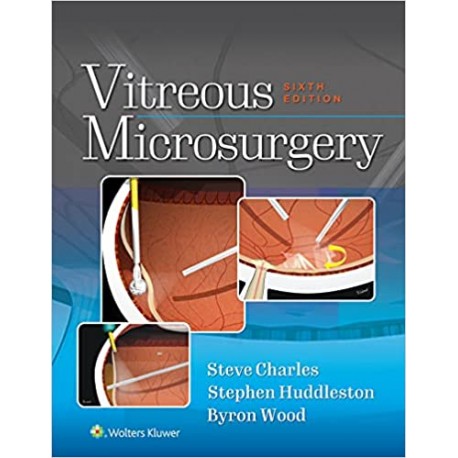 Vitreous Microsurgery