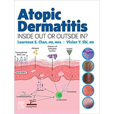 Atopic Dermatitis: Inside Out or Outside In