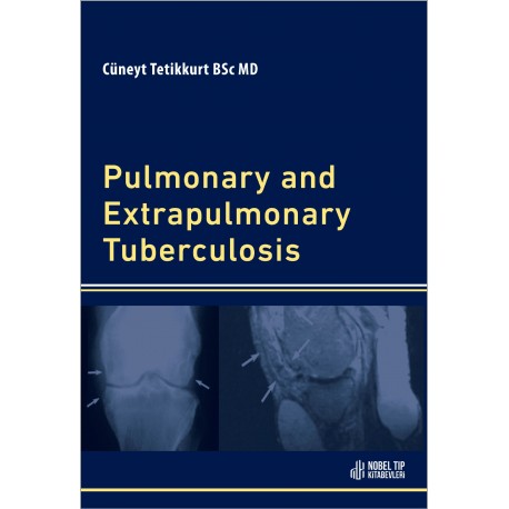 Pulmonary and Extrapulmonary Tuberculosis