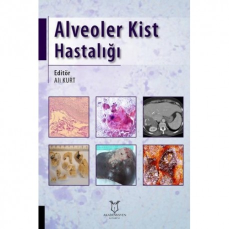 Alveoler Kist Hastalığı