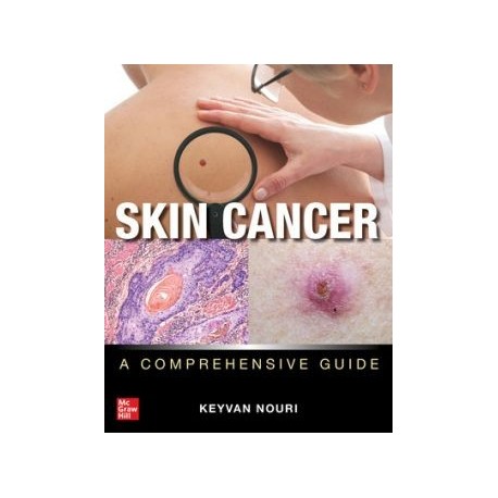 Skin Cancer: A Comprehensive Guide