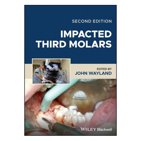 Impacted Third Molars, 2nd Edition