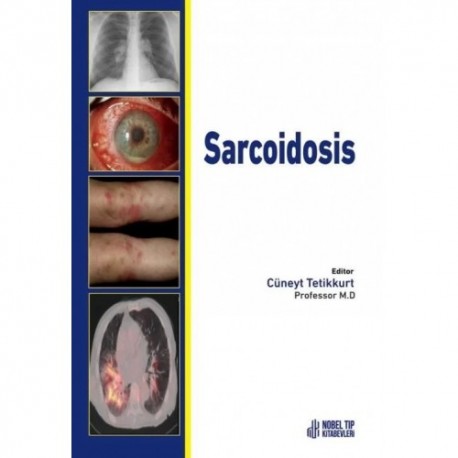 Sarcoidosis