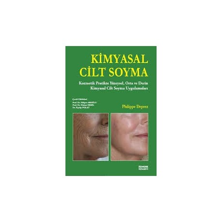 Kimyasal Cilt Soyma