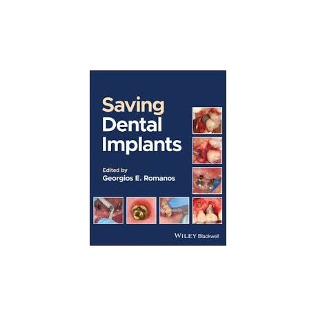 Saving Dental Implants