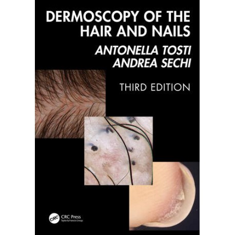 Dermoscopy of the Hair and Nails,3rd Edition